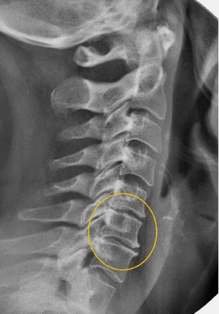 Osteochondrose der Halsspalte in einer X -Linie